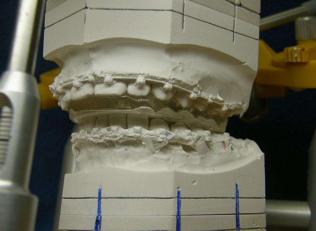Bimaxilläre Umstellungsosteotomie OP Splints
