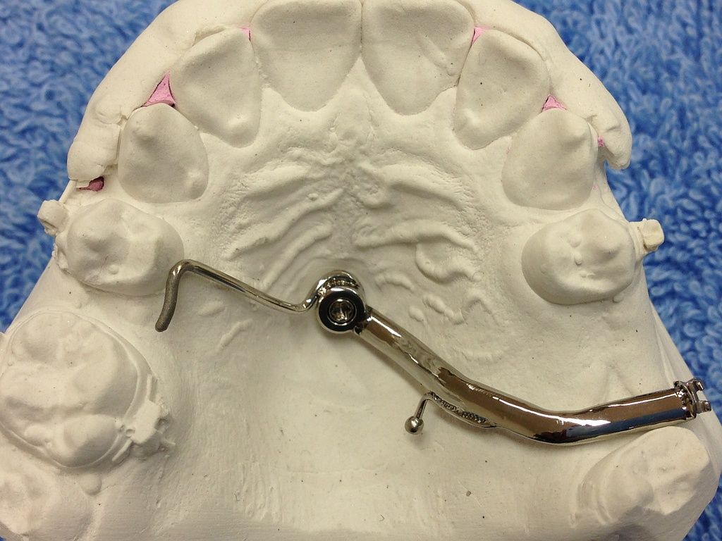 Gaumenimpl. mit Bracketbügel