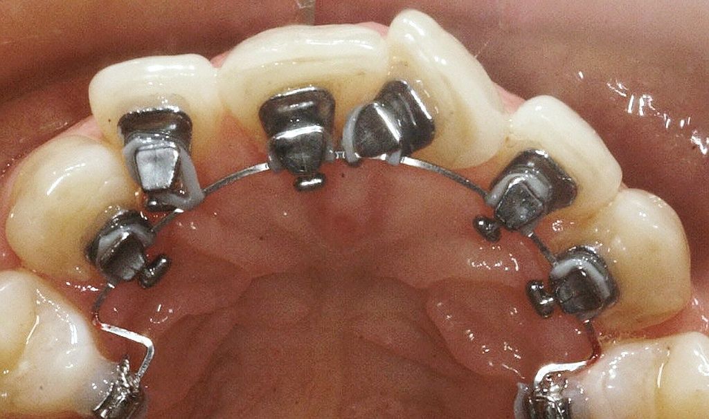 Lingualtechnik mit 3D Brackets Ormco