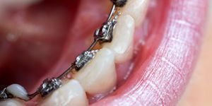 Lingualtechnik - unsichtbare Zahnspange - Dental Design Ilg