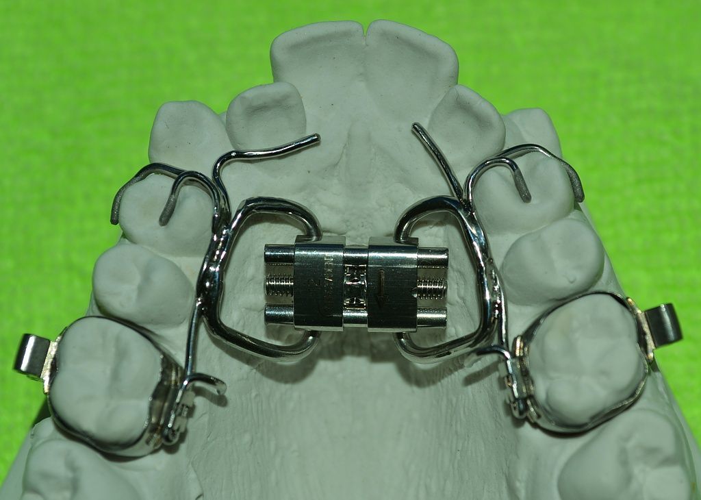 Forc.Dehnapp. gesteckt