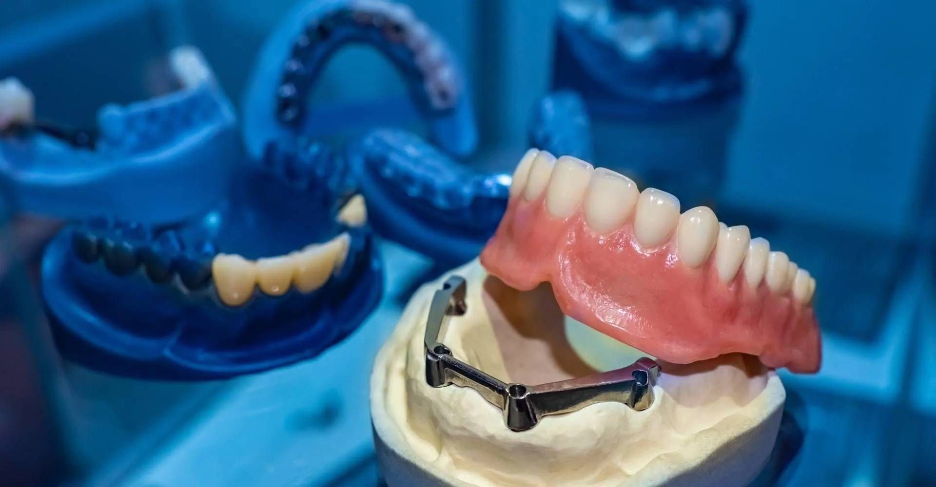 Zahnimplantate und Zahnprothesen, dargestellt auf Gipsmodellen und blauen Harzabgüssen.