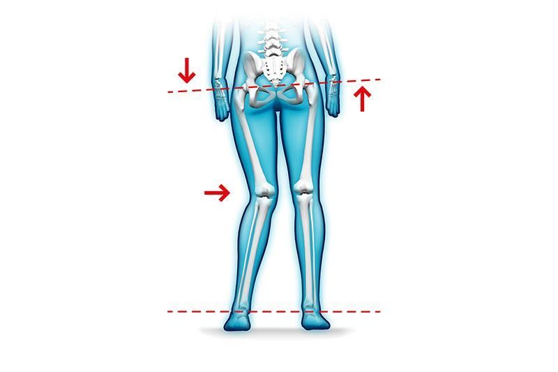 Das Skelett einer Frau ist mit Pfeilen dargestellt, die auf Knie und Hüfte zeigen.