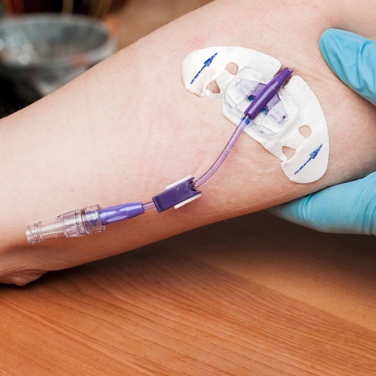 Cathéter intraveineux fixé avec du ruban adhésif sur l'avant-bras d'un patient, avec un tube violet attaché