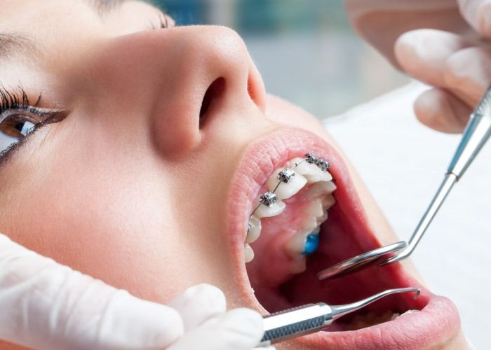 Un dentista ajusta los aparatos de ortodoncia dentro de la boca abierta de un paciente utilizando instrumentos metálicos.