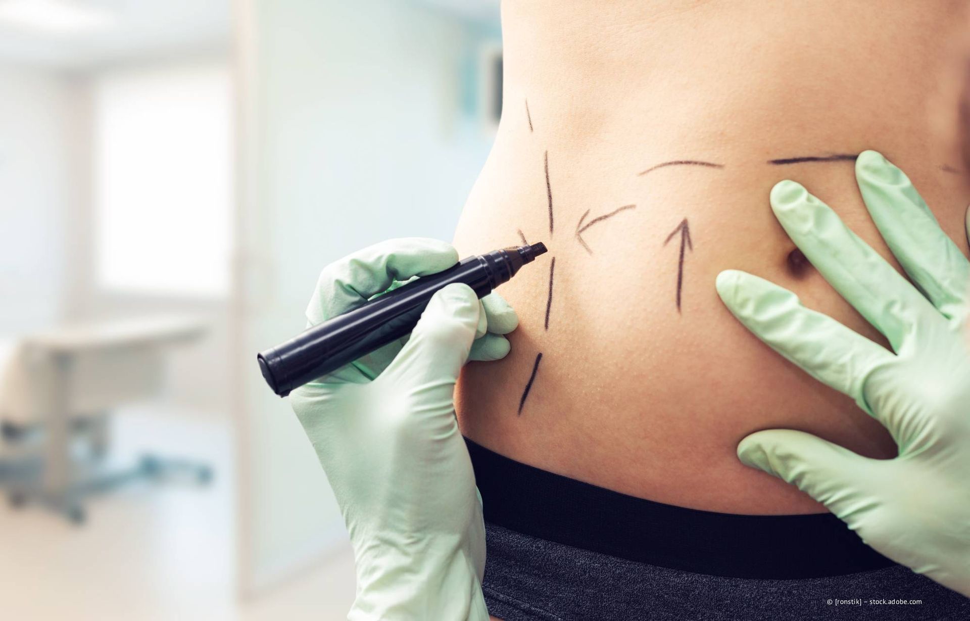 Hände in medizinischen Handschuhen zeichnen Linien auf den Bauch einer Person, wahrscheinlich für einen chirurgischen Eingriff.