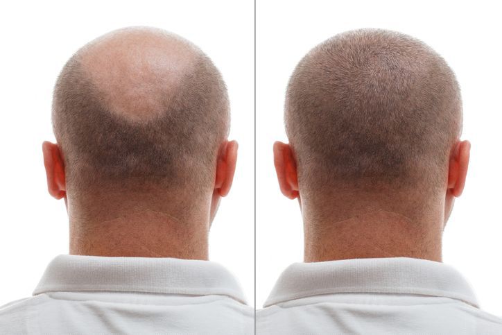 Before und After für eine Haarpigmentierung in München