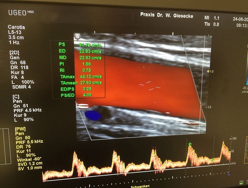 Ultraschallbild mit roter Doppler-Blutflussüberlagerung und Wellenformdiagramm unten