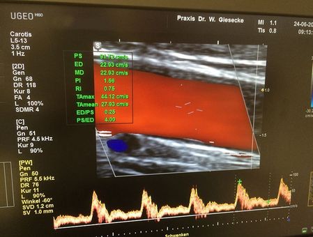 Ultraschallbild mit roter Doppler-Blutflussüberlagerung und Wellenformdiagramm unten