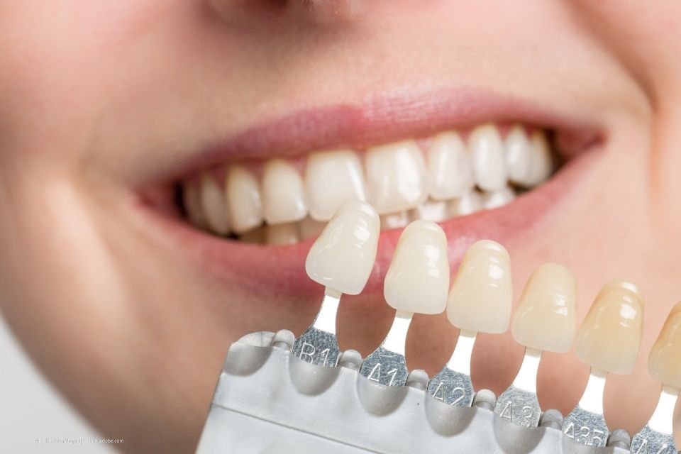 Zahntechniker gleicht das Weiß der Zähne ab