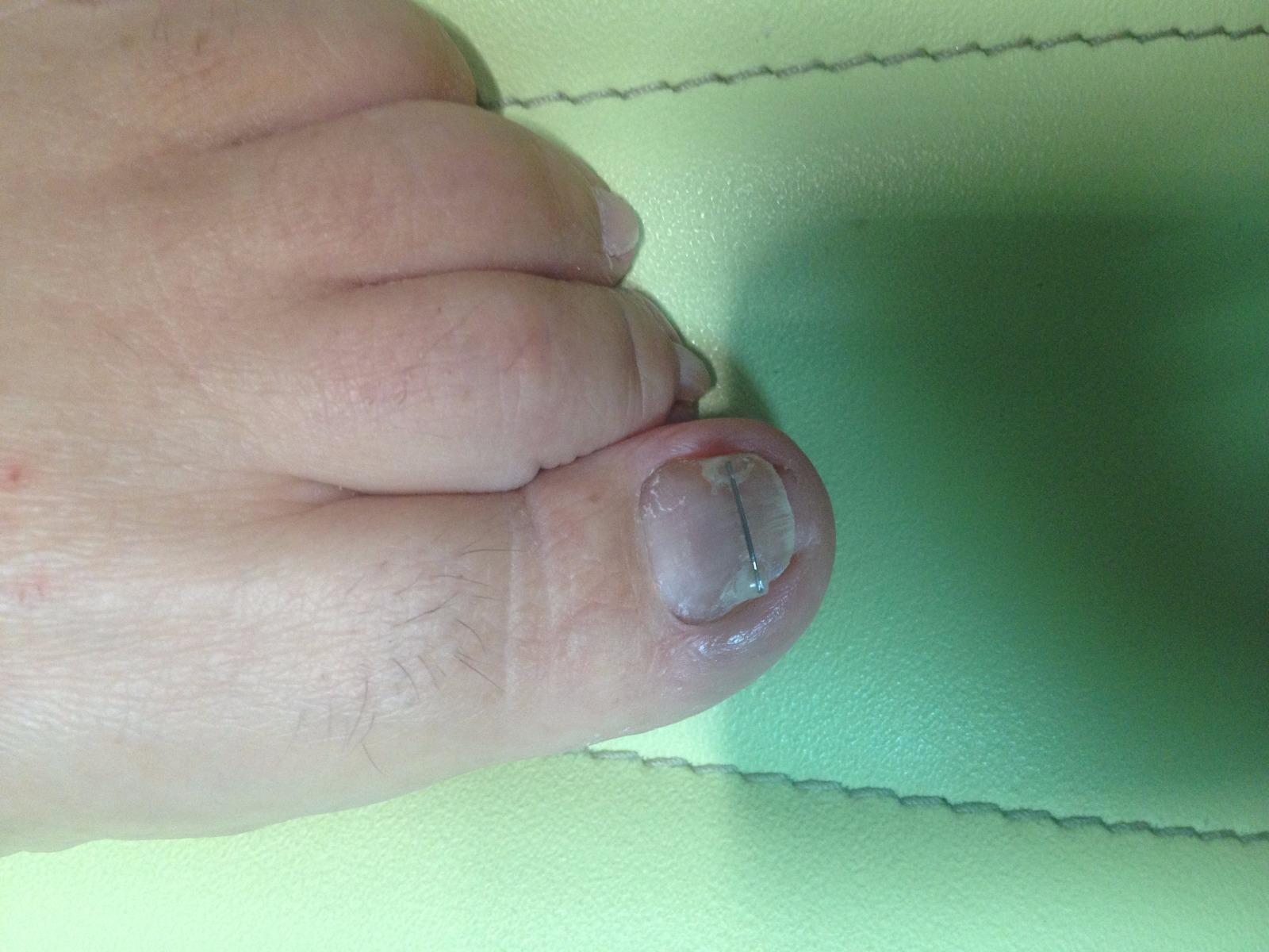 Pédicure-Podologue LAVAUR Traitement d'un ongle incarné plicaturé grâce à une orthonyxie (6 mois après)