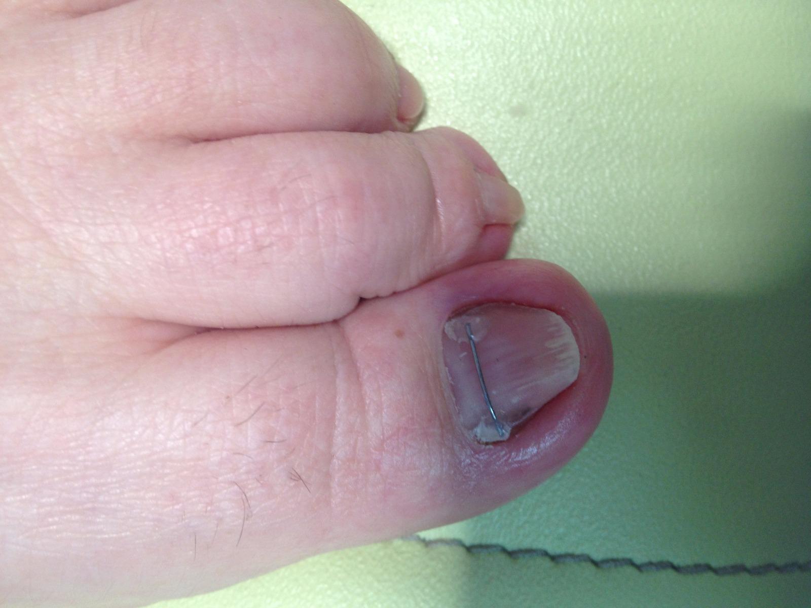 Pédicure-Podologue LAVAUR Traitement d'un ongle incarné plicaturé grâce à un orthonyxie (Jour 0)