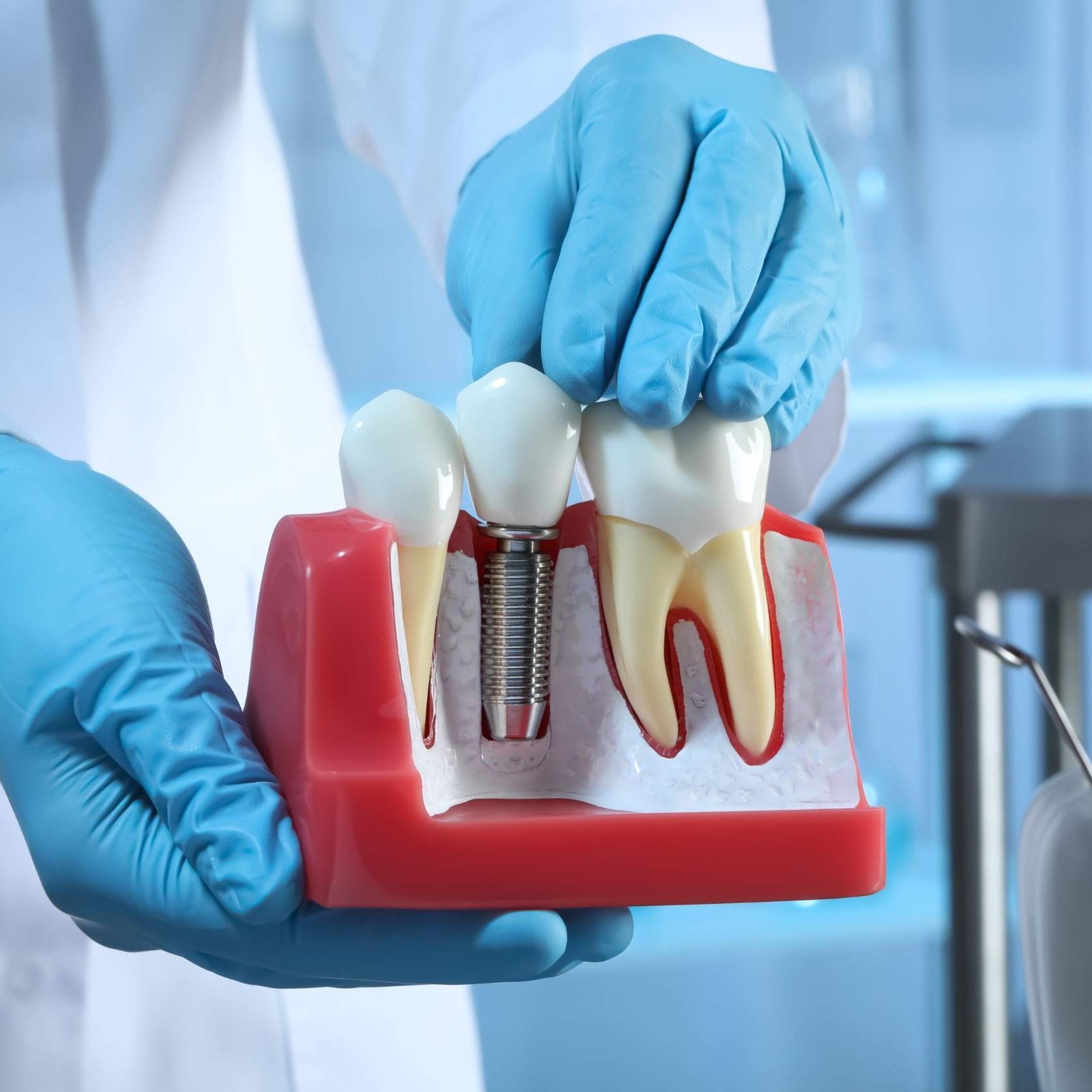 Un dentista sostiene un modelo de un diente con un implante dental en él.