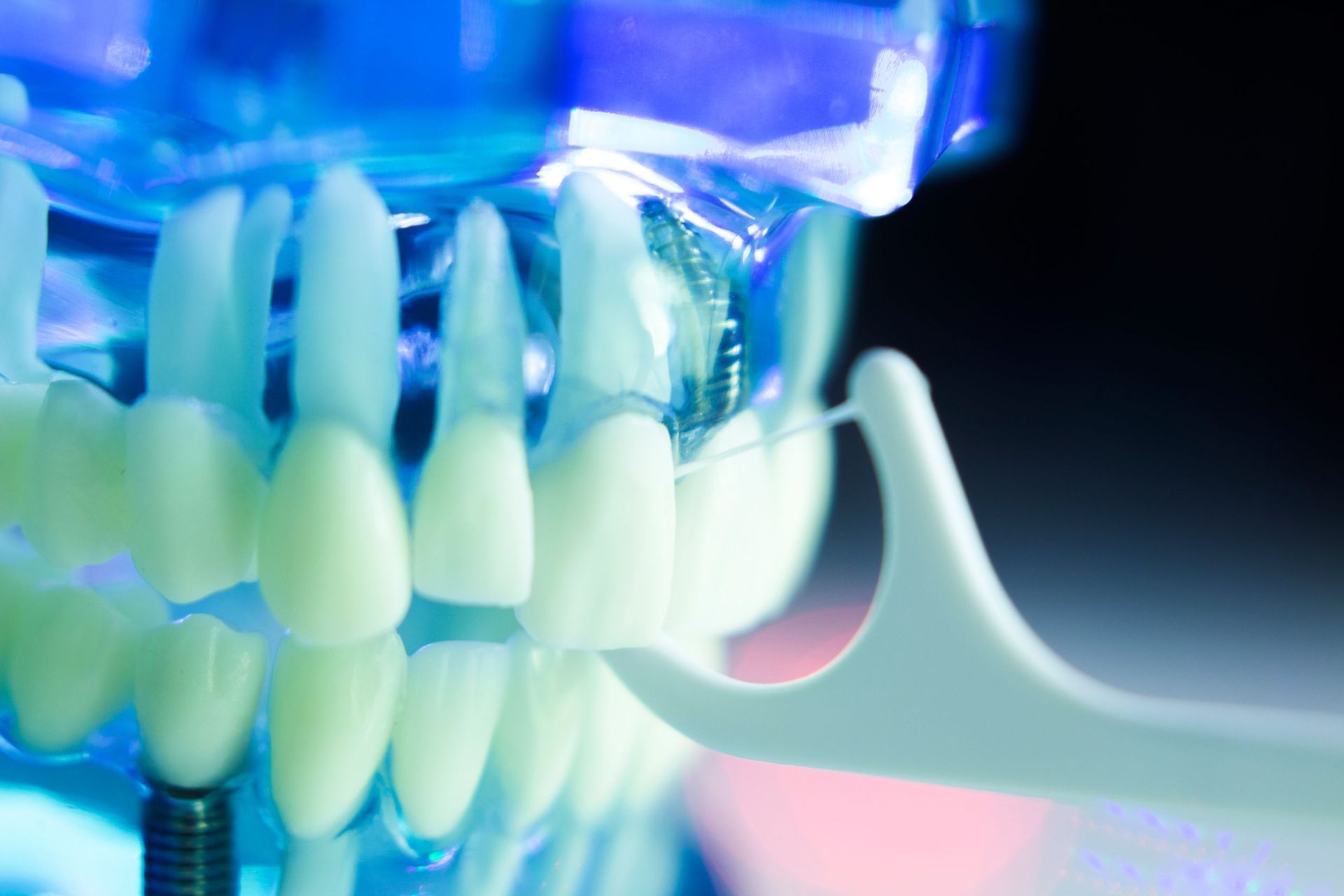 Un primer plano de un modelo de un diente con un implante dental.