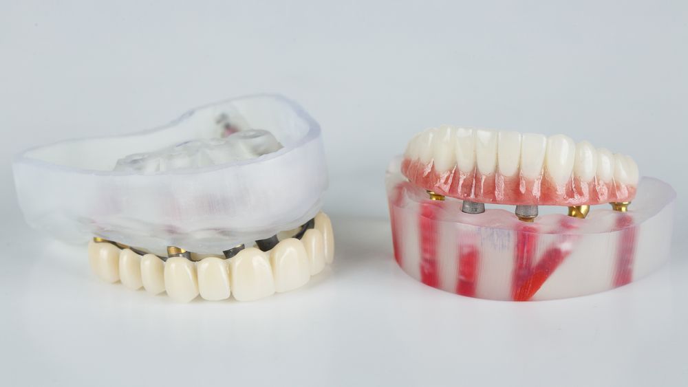 Un modelo de un puente dental y un modelo de un implante dental.