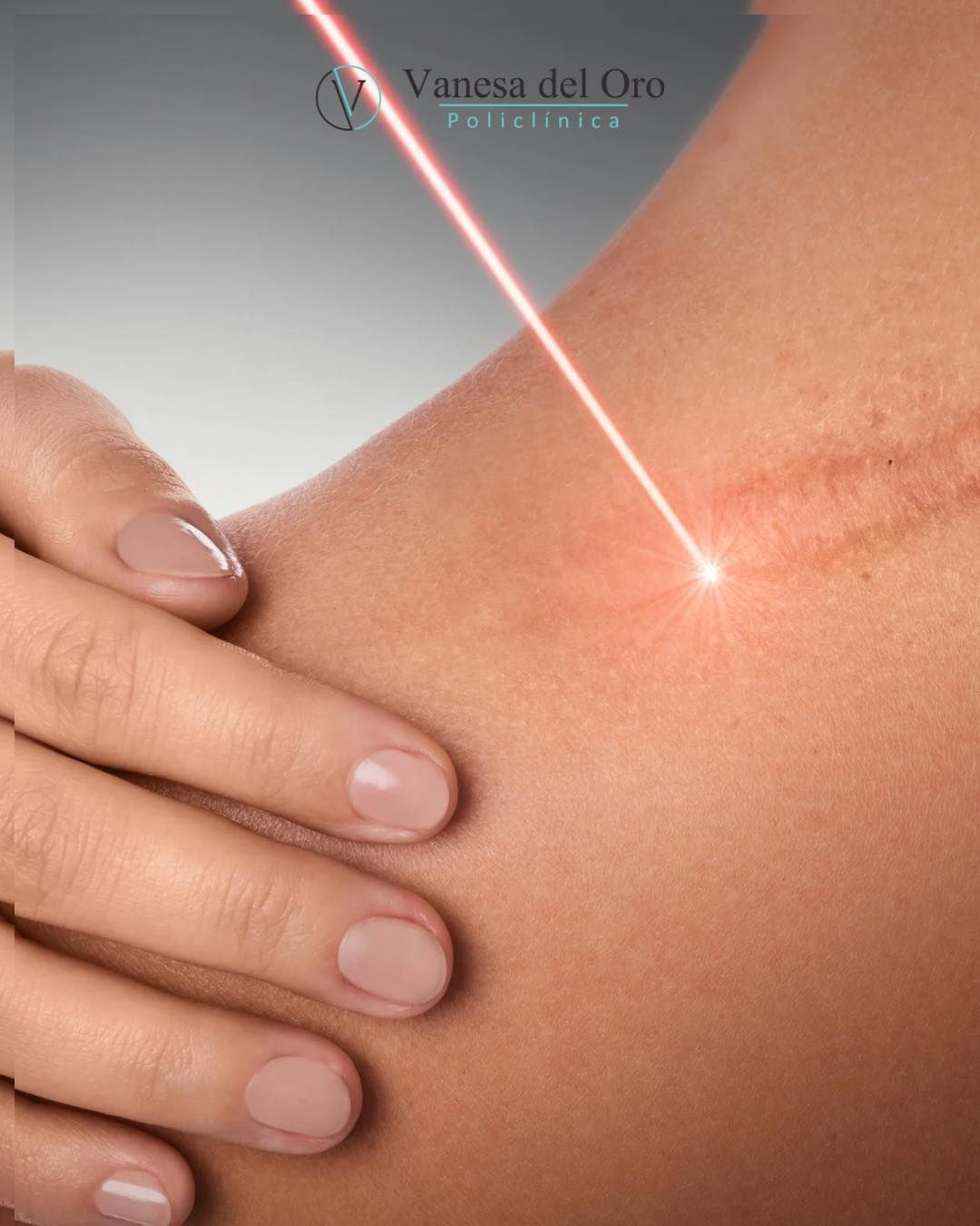 Una persona está recibiendo un tratamiento con láser en el cuello.