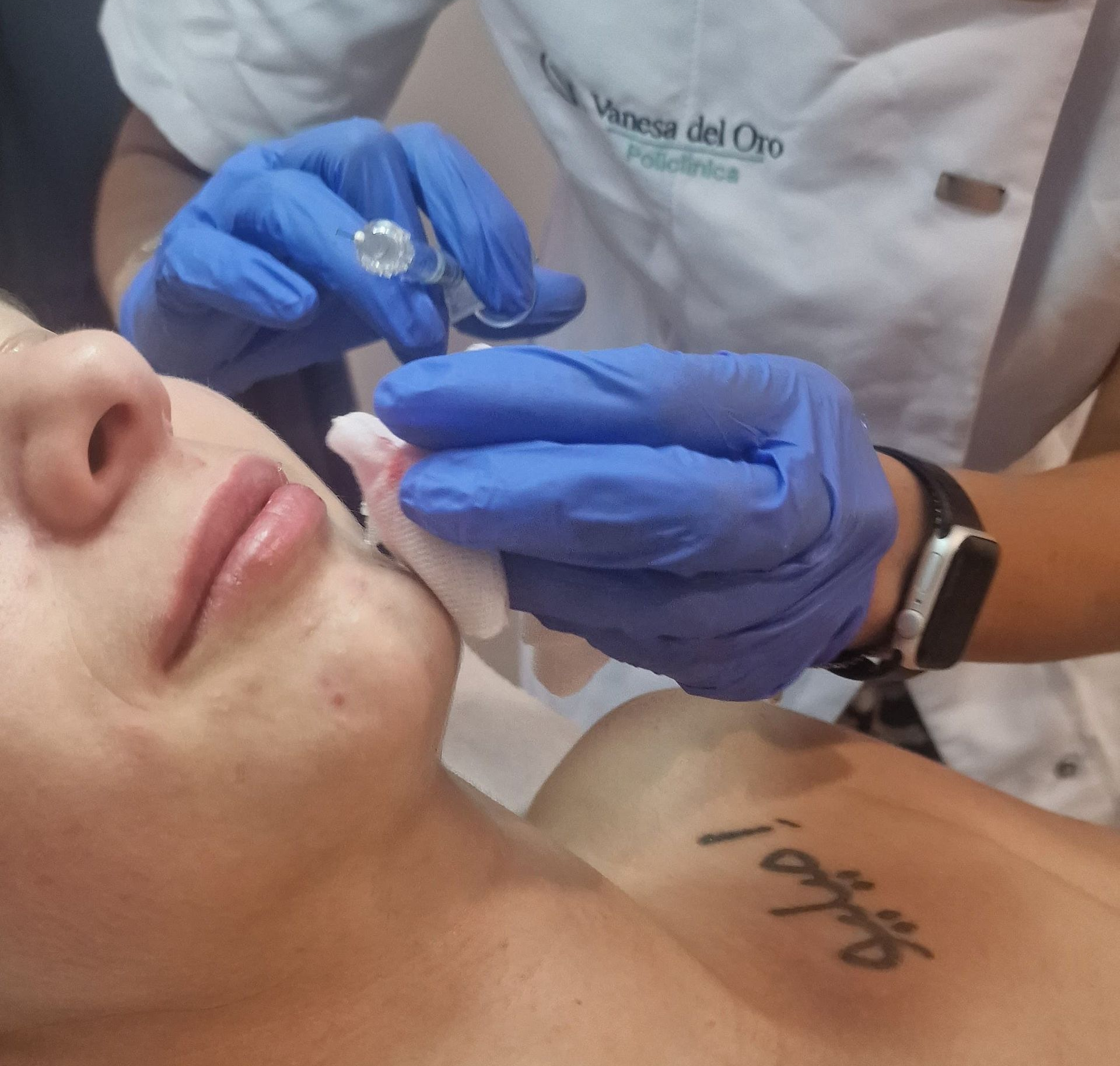 Primer plano del rostro de una persona con la piel descamada alrededor de la boca y el mentón, probablemente después de una exfoliación química.