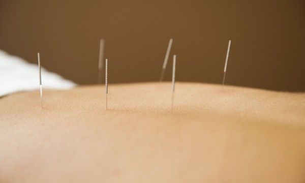 Una persona está recibiendo acupuntura en la espalda.