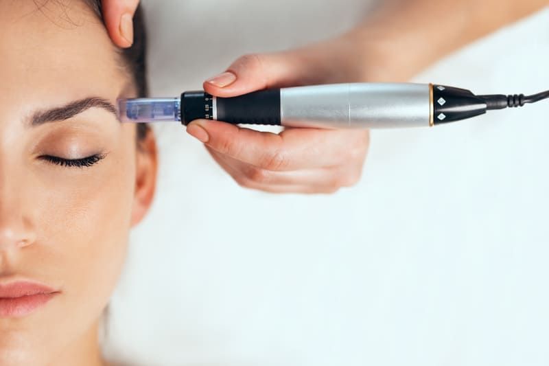 Skin Pen Microneedling | Beautykiss Aesthetics