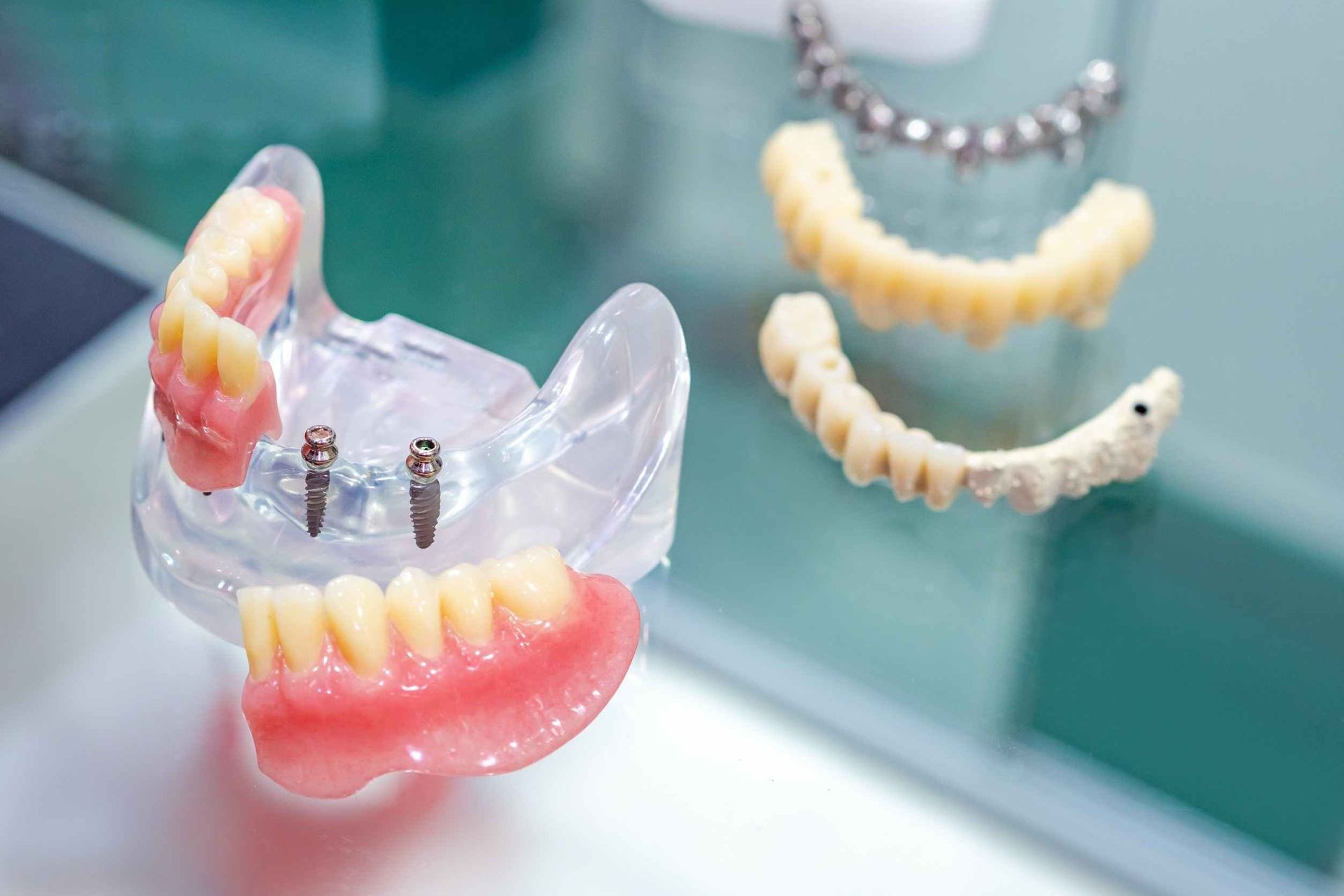 Un modelo de una dentadura con implantes dentales sobre una mesa.