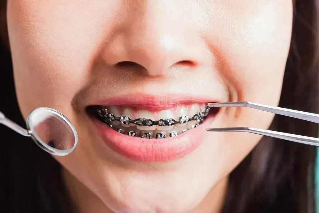 Una mujer con aparatos ortopédicos se hace examinar los dientes por un dentista.