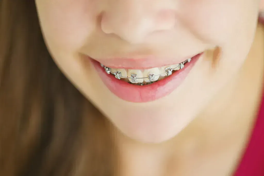 Un primer plano de la boca de una niña con aparatos dentales.