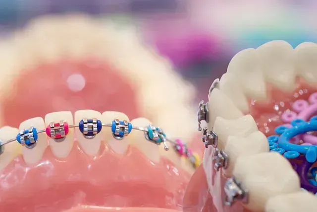 Un primer plano de un modelo de dientes con aparatos ortopédicos.