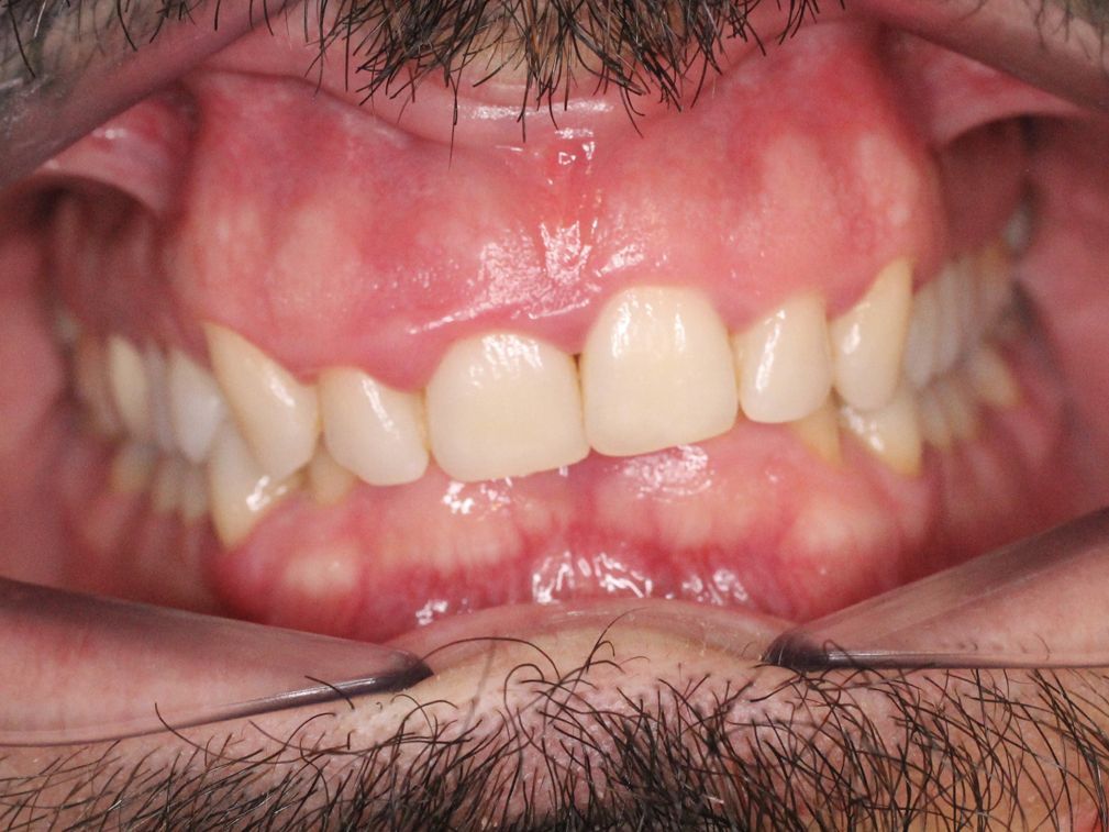 Primer plano de los dientes de un adulto, que muestra inflamación de las encías.
