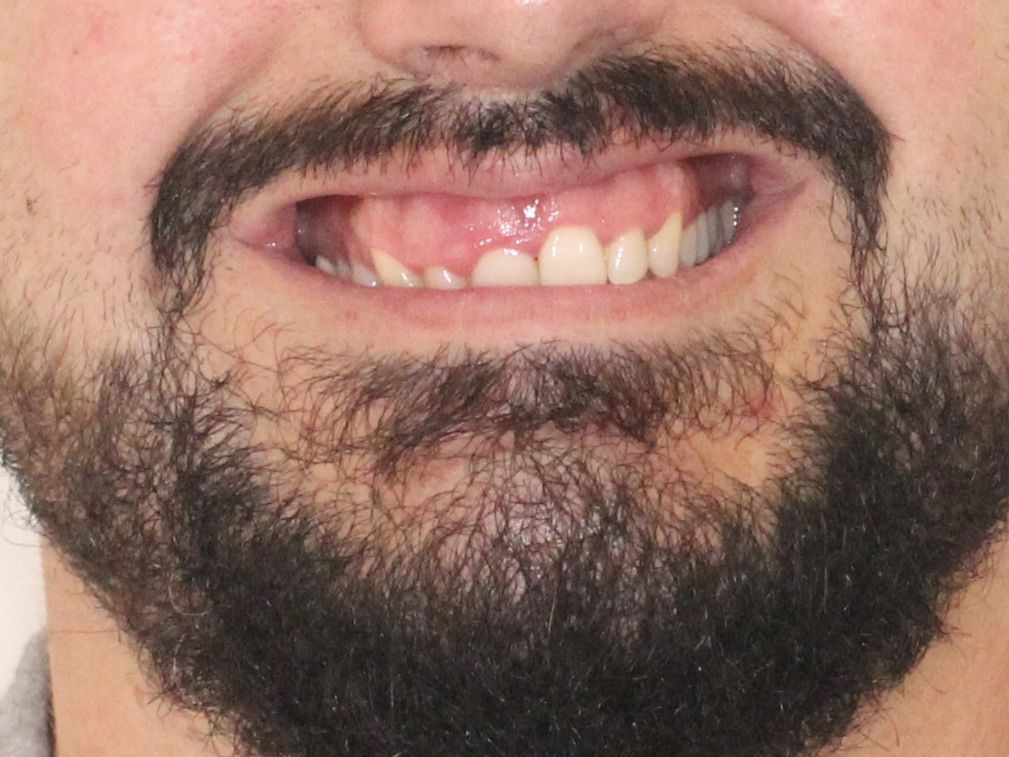 Hombre con barba oscura sonriendo, mostrando los dientes superiores.