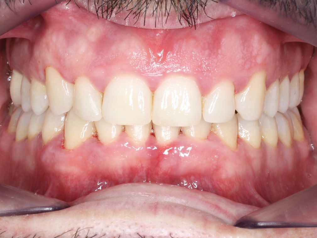 Primer plano de la boca de una persona, mostrando dientes bien alineados, de color claro y encías sanas.