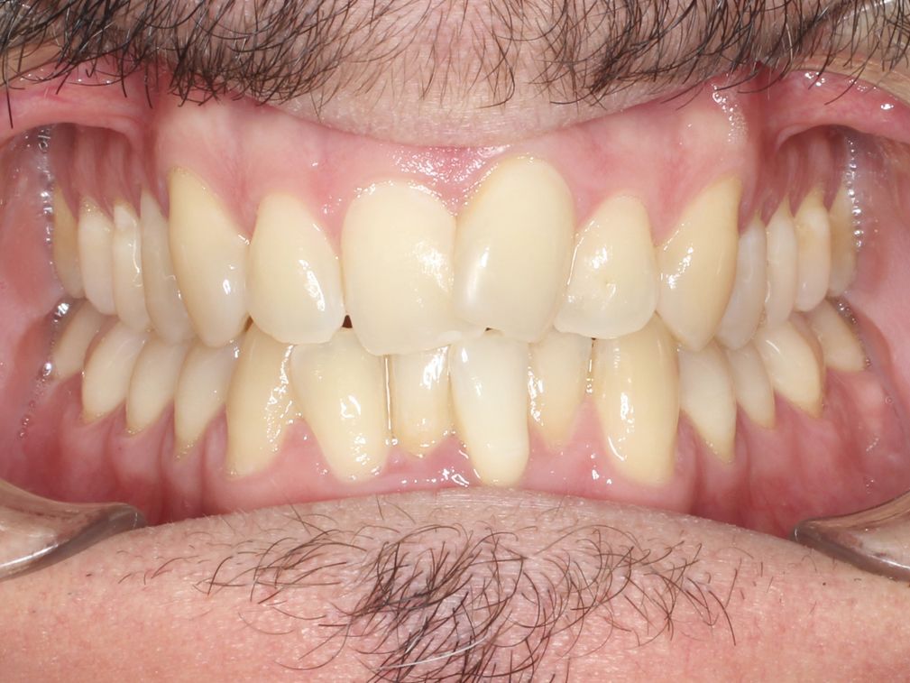 Primer plano de los dientes; color amarillento; conjunto completo a la vista, boca abierta.