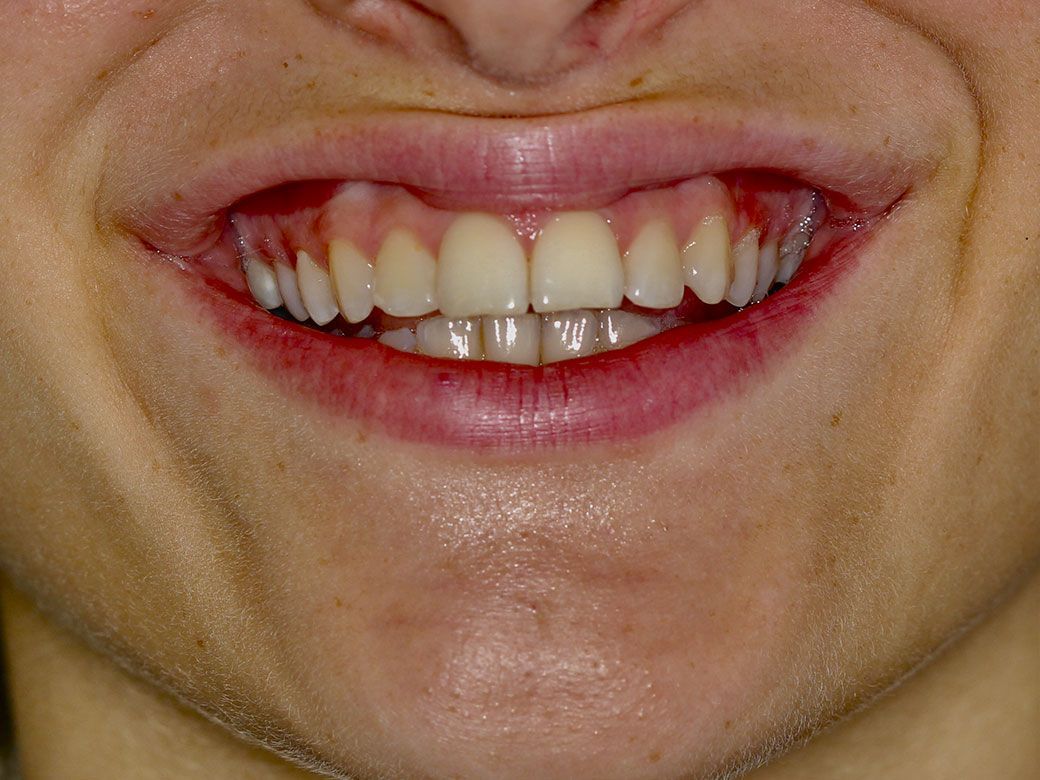 Un primer plano de los dientes de una persona con una corona en uno de ellos.