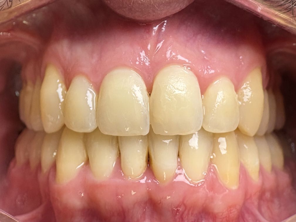 Primer plano de la dentadura de una persona, mostrando los dientes superiores e inferiores. Los dientes frontales son de color claro.