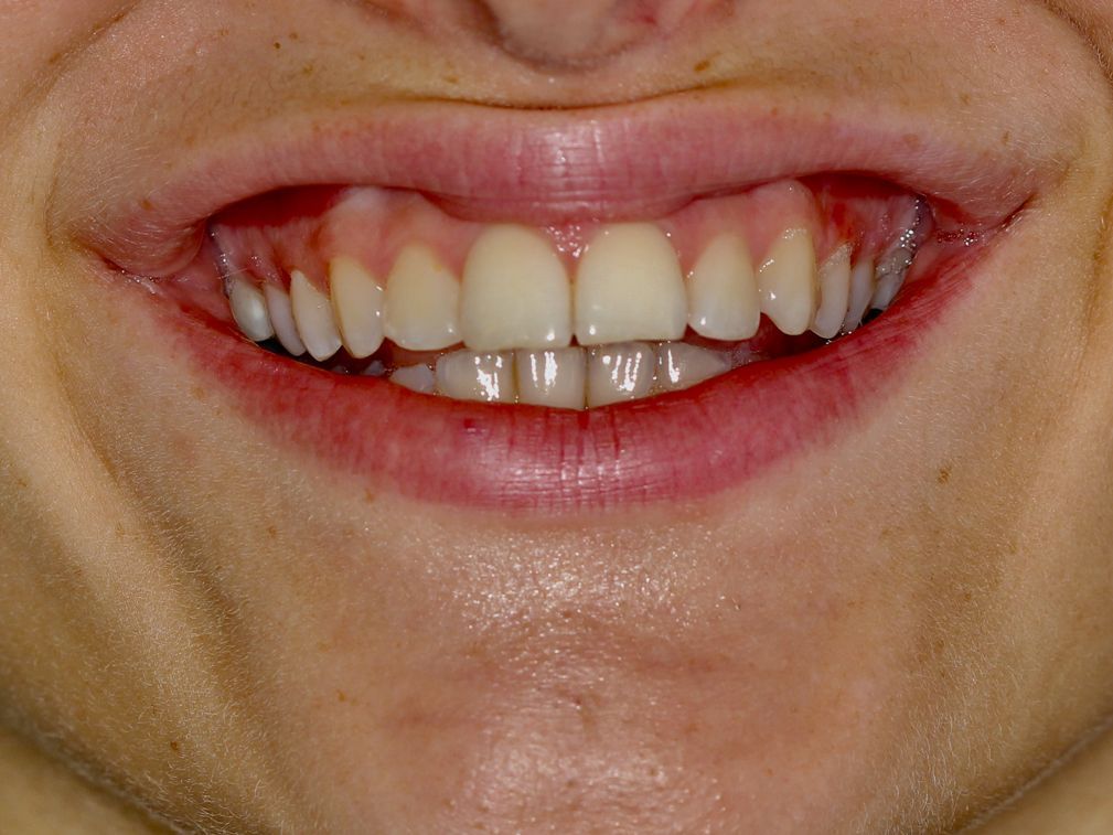 Primer plano de una persona sonriendo, dejando al descubierto dientes y encías rojas.