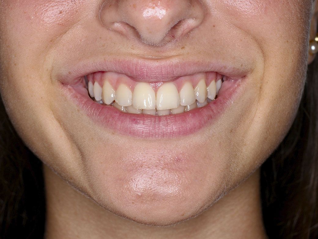 Un primer plano de los dientes de una persona con un protector bucal transparente.