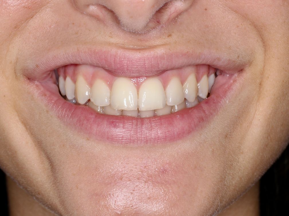 Primer plano de una persona sonriendo, mostrando dientes blancos y sanos. Se aprecian encías y labios rosados.
