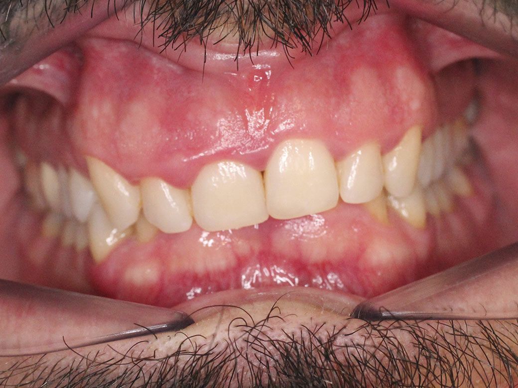 Un primer plano de los dientes de una persona con una corona en uno de ellos.