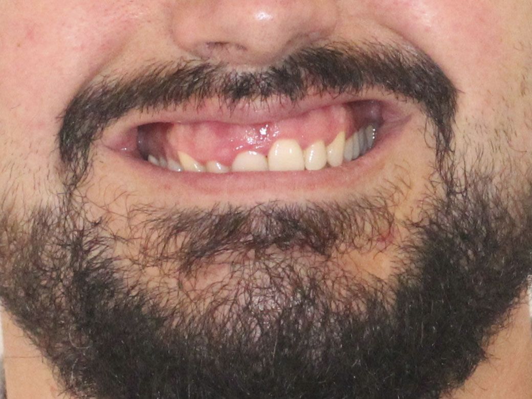 Un primer plano de los dientes de una persona con una corona en uno de ellos.