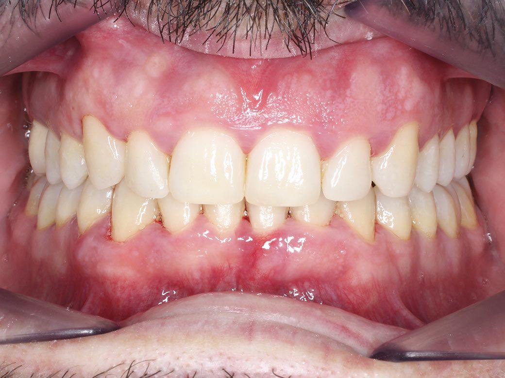Un primer plano de los dientes de una persona con un protector bucal transparente.