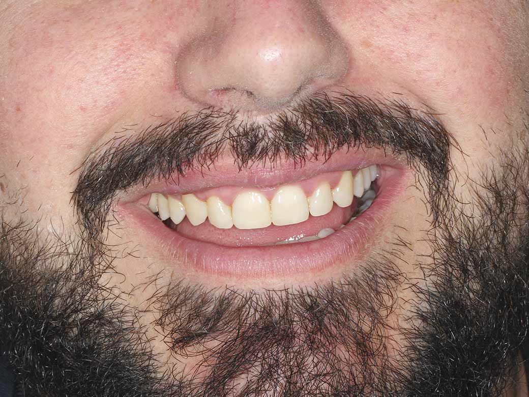 Un primer plano de los dientes de una persona con un protector bucal transparente.