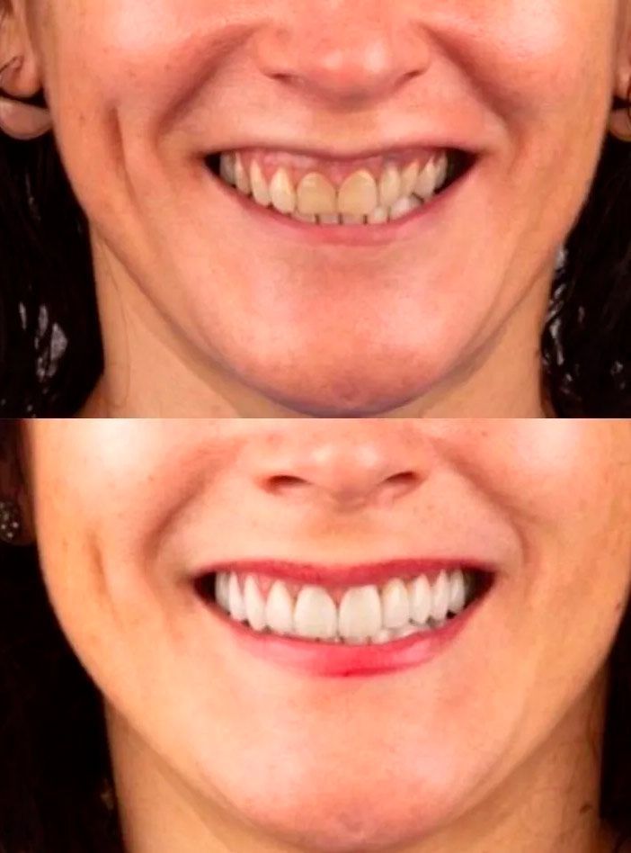 Una foto de antes y después de los dientes de una mujer.