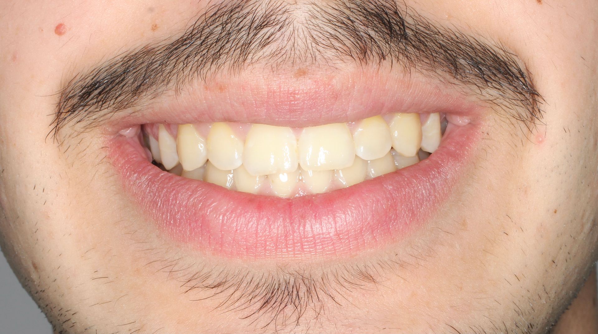 Un primer plano de la sonrisa de una mujer con dientes blancos.