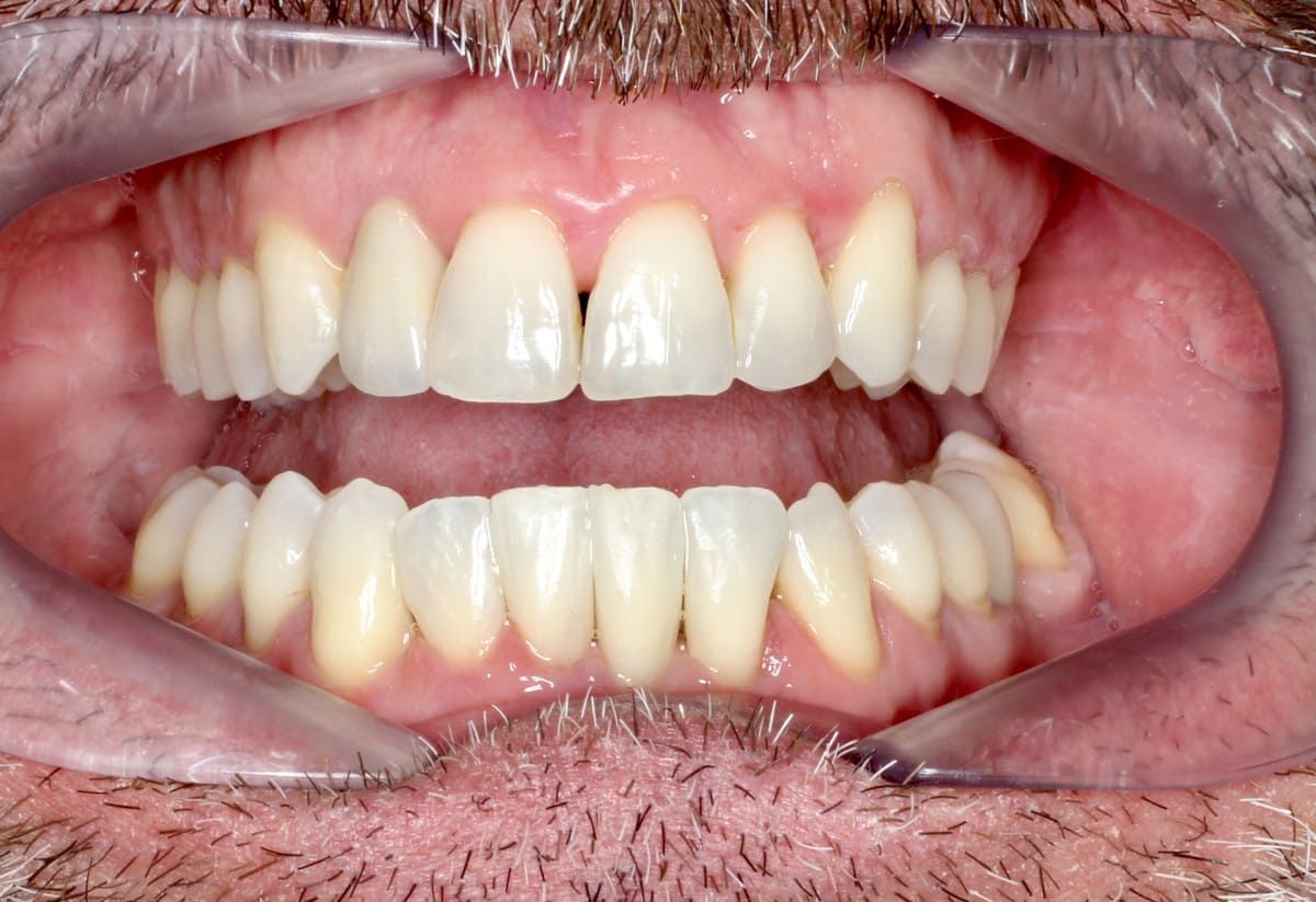 Un primer plano de la boca de una persona con sus dientes visibles.