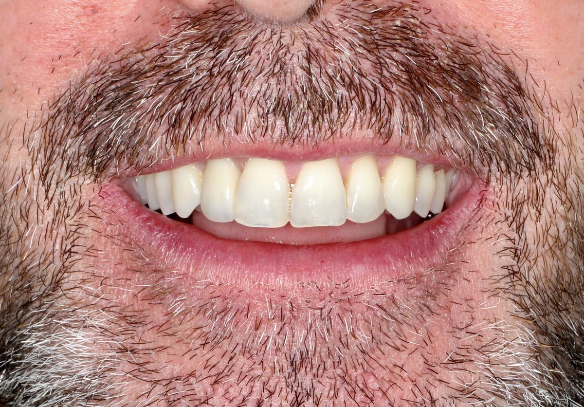 Un primer plano de la boca de un hombre con dientes blancos.