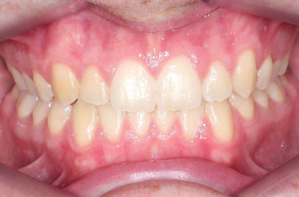 Primer plano de los dientes y las encías, mostrando los dientes frontales superiores e inferiores dentro de una boca abierta.