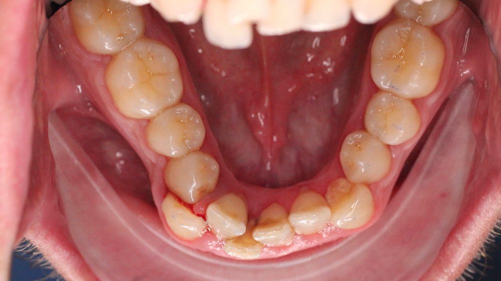 Close-up of lower teeth and gums, showing a dental arch with some crowding and redness.
