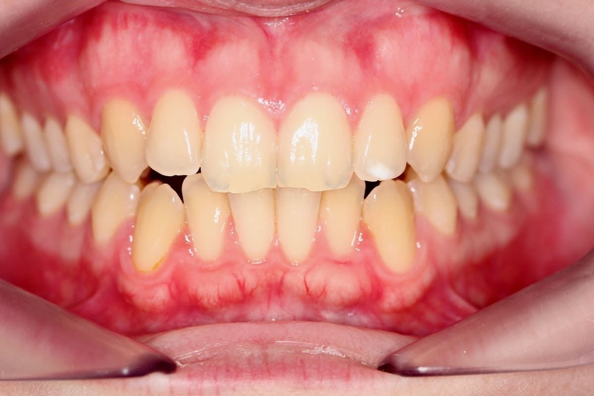 Un primer plano de la sonrisa de una mujer con dientes faltantes.
