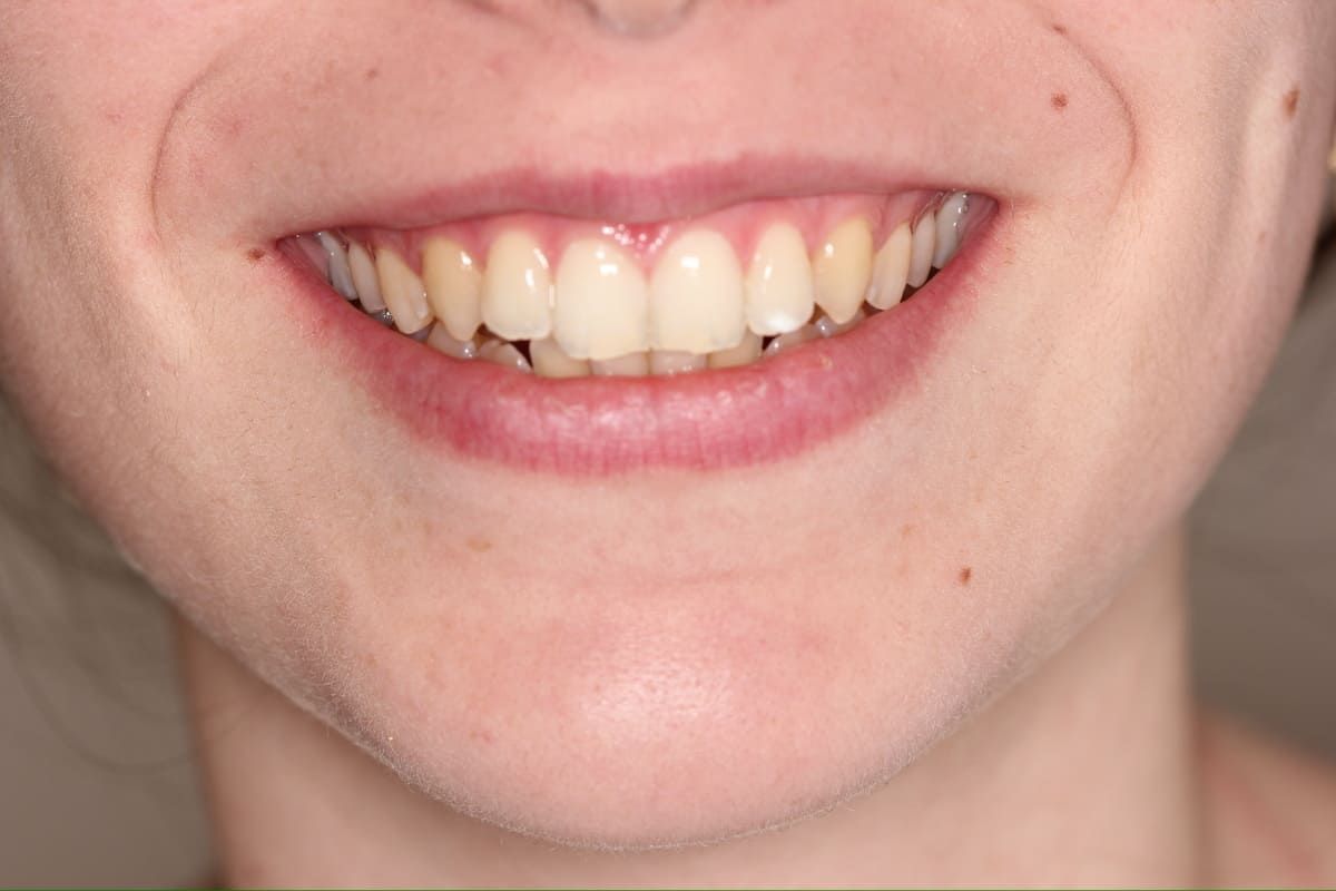 Un primer plano de la sonrisa de una mujer con dientes faltantes.