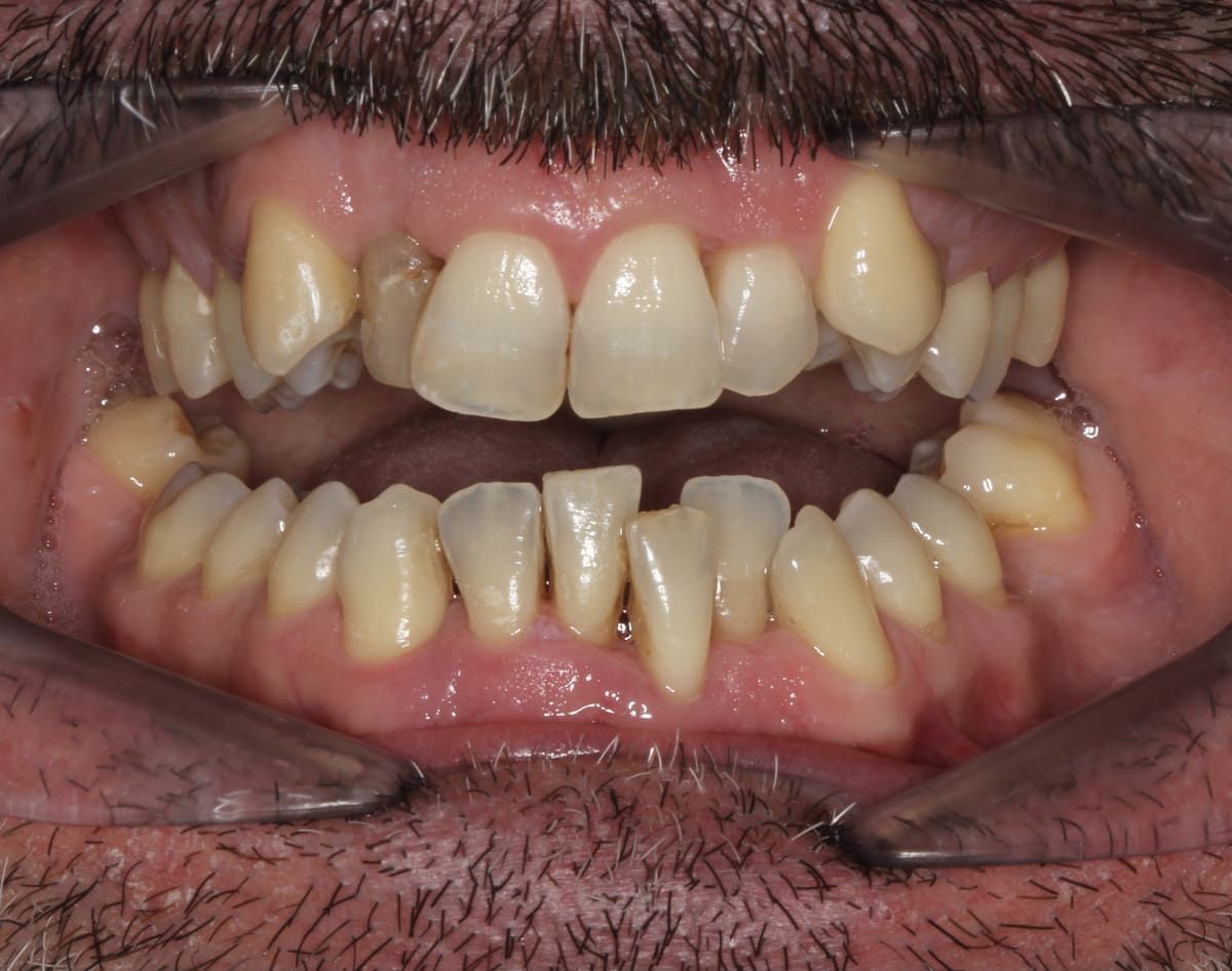 Un primer plano de la boca de una persona con sus dientes visibles.