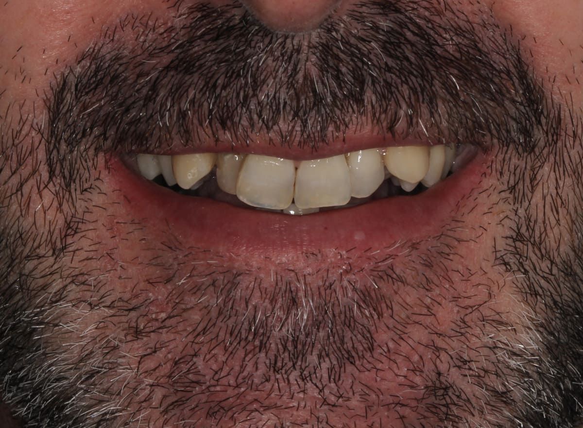 Un primer plano de la boca de un hombre con dientes blancos.